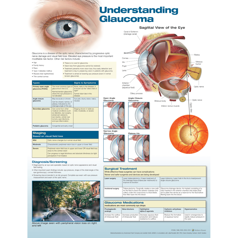 Understanding Glaucoma