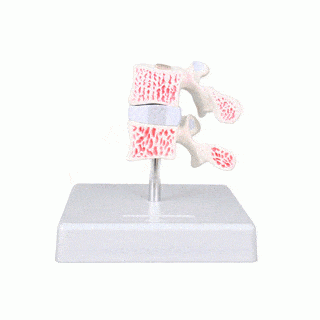 Anatomical Model Osteoporosis Model Cross Section of Two Vertebra