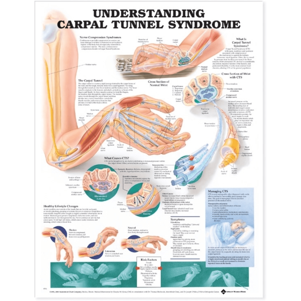 Understanding Carpal Tunnel Syndrome Anatomical Chart